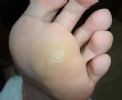 轻度的鸡眼可以使用两个中医小秘方