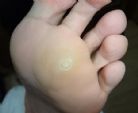 轻度的鸡眼可以使用两个中医小秘方